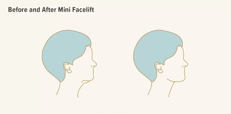 346708-Everything-You-Need-to-Know-About-Mini-Facelift-1296x728-Body-e1649407980737