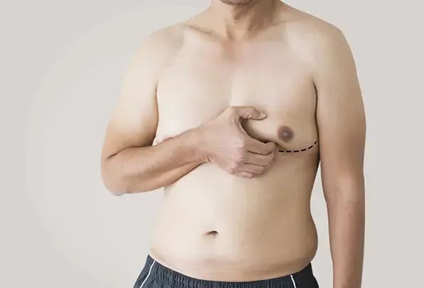 Gynecomastia-patient