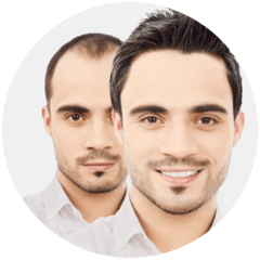 Hair Transplant
