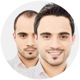 Hair Transplant