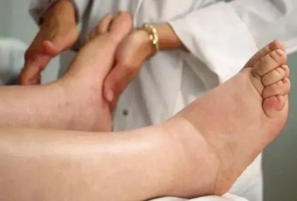 Lymphedema