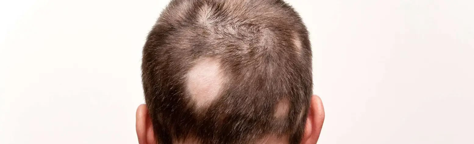 alopecia-areata