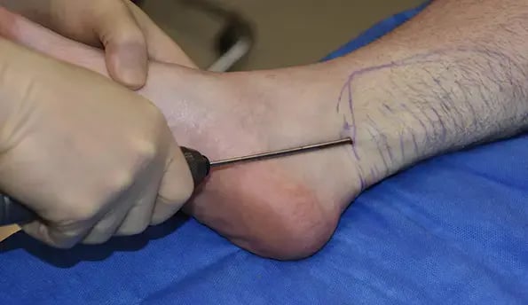 ankle-liposuction-surgery