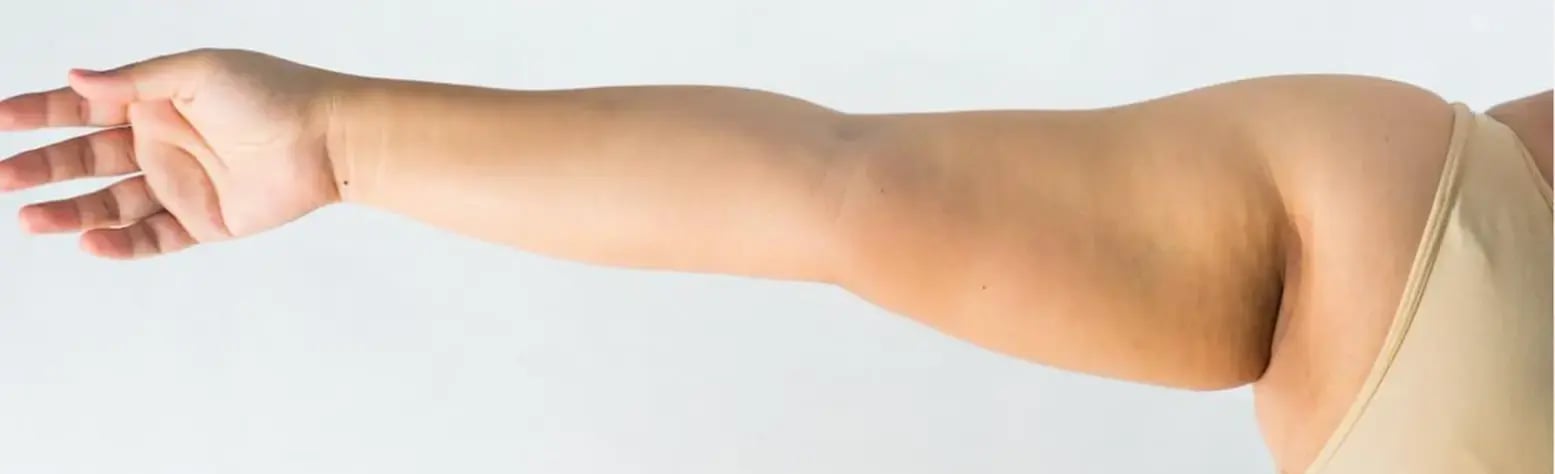 arm-lipedema-treatment