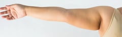 What is Arm Lipedema and How Do You Treat It?