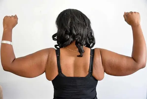 arm-lipedema