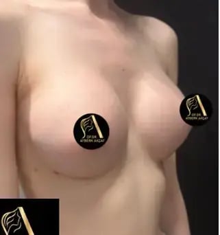 ayberk-akcay-breast-augmentation-before-after-3