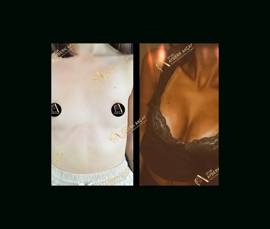 ayberk-akcay-md-breast-augmentation-before-after-2-1