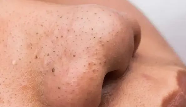 blackheads-problem