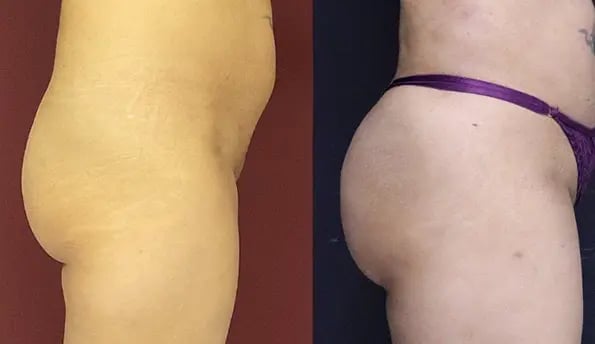 brazilian-butt-lift-before-after