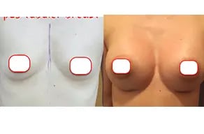 breast-aug-before-after-1