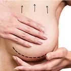Breast Lift