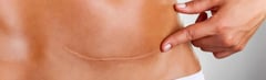 C- Section Recovery