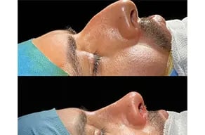 Side view of a nose before rhinoplasty (top) and at the end of surgery (bottom), by Dr. Cenk Teker