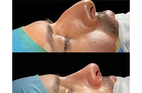 canetli-cenk-teker-rhinoplasty-before-and-after