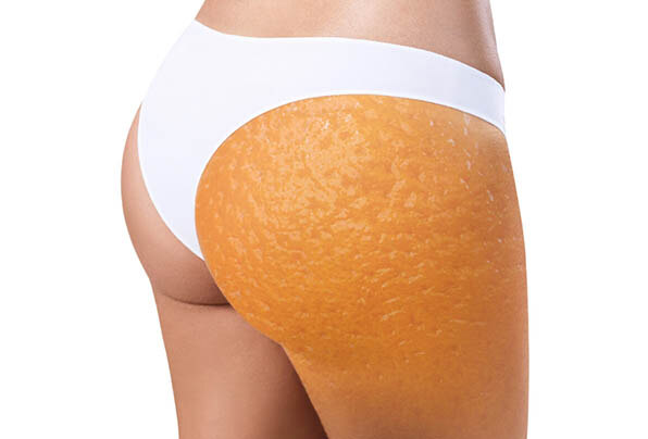 causes-cellulite