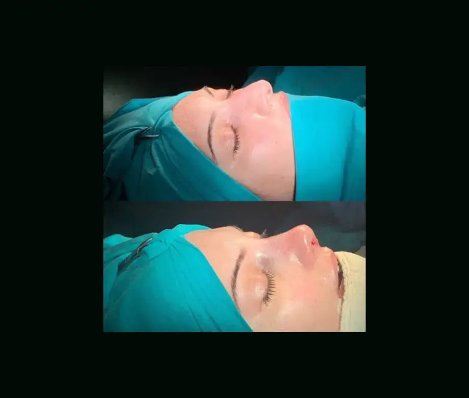 cenk-teker-md-rhinoplasty-before-after-7
