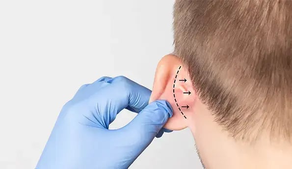 cosmetic-ear-surgery