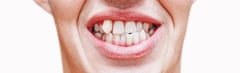 What Causes Crooked Teeth?