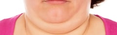 What Causes a Double Chin?