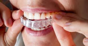 Invisalign