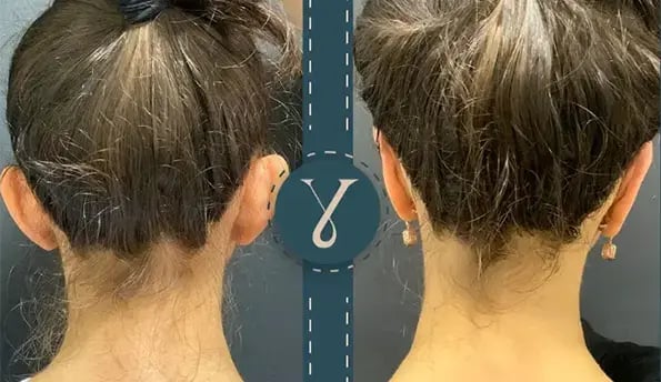 ear-surgery-before-after-by-yalcin-bayram