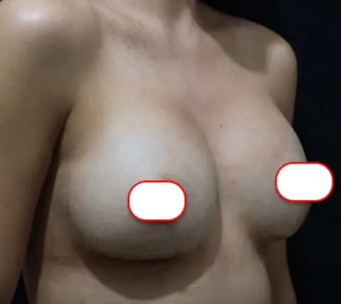 ekrem-breast-1