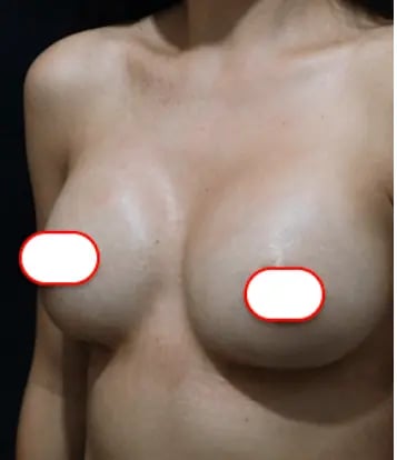 ekrem-breast-2