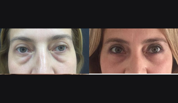 ekrem-keskin-eyelid-surgery-before-after