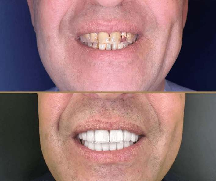 emg-clinic-dental-implant-before-after-1