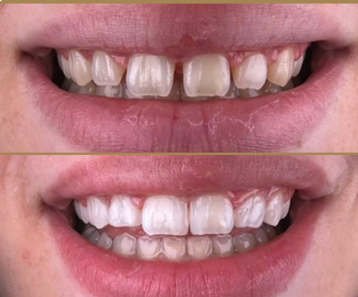 emg-clinic-dental-implant-before-after-2
