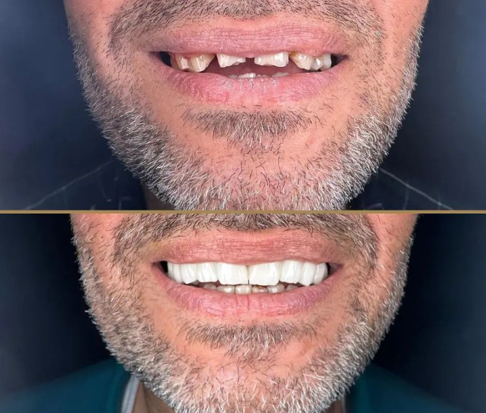 emg-clinic-dental-implant-before-after-3