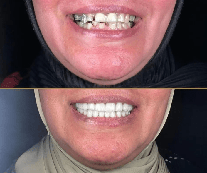emg-clinic-dental-implant-before-after