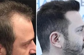 emphair-before-after