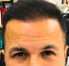 St*** after hair transplant