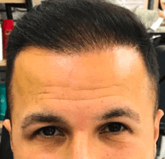 The result of my 14th month in hair transplantation