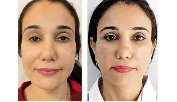 face-lift-before-after-1