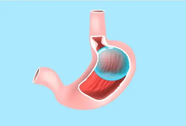 gastric-balloon-cost