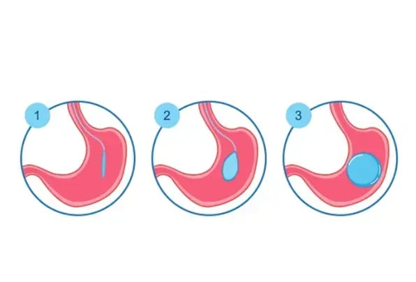 gastric-balloon-procedure