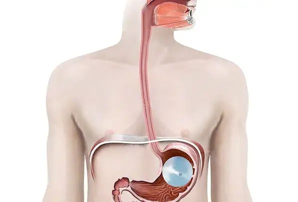 gastric-balloon-recovery