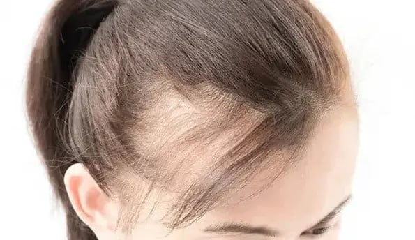 hair-loss-for-woman