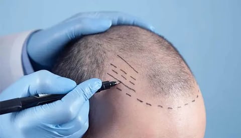 PRP for Hair Loss