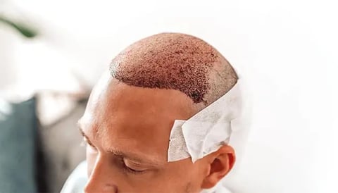 DHI Hair Transplant