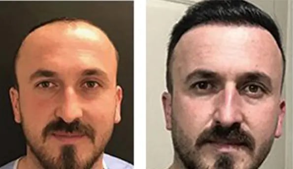 hair-transplant-before-after