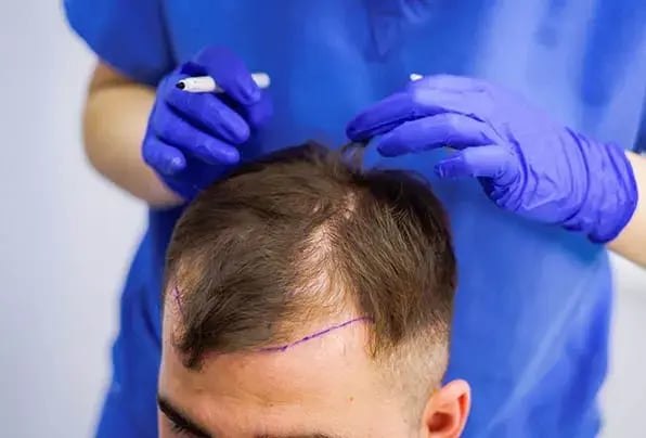 Hair transplant planning: the treatment area is measured and marked