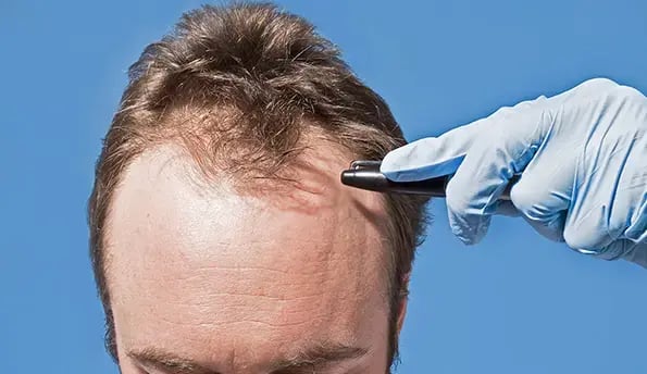 hair-transplant-in-istanbul