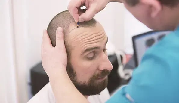 hair-transplant-price