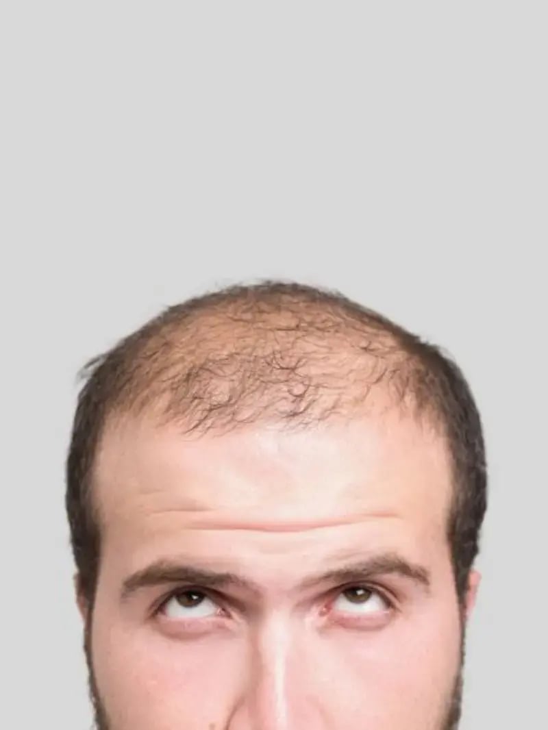 hair-transplant-recovery