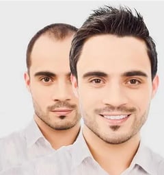 Hair transplant