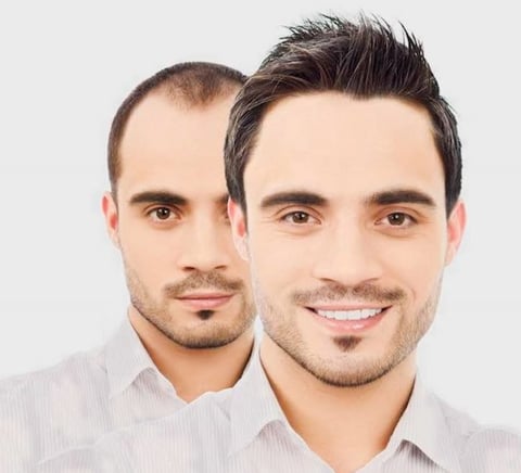 FUE Hair Transplant